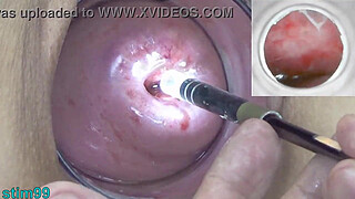 Watch inside the uterus of Asian woman with Endoscope camera into Cervix